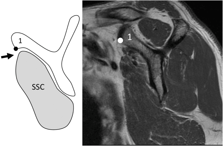 Oblique sagittal MRI and schematic showing mild subscapularis atrophy with caudal tendon shift