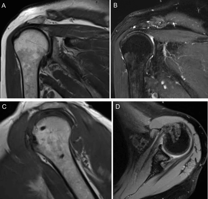 Four-panel postoperative shoulder MRI (A-D) in coronal, sagittal and axial planes after rotator cuff and subscapularis repair