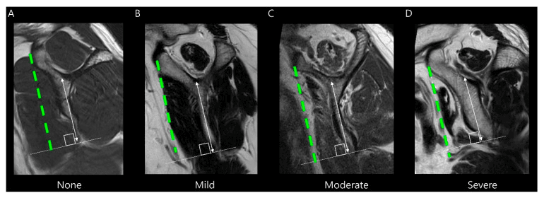 Oblique sagittal MRI examples labelled none, mild, moderate and severe subscapularis atrophy (A-D), with green dashed and white measurement lines
