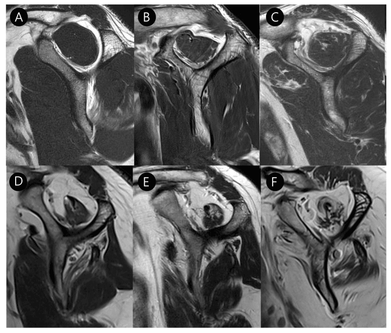 Six oblique sagittal MRI panels (A-F) showing progressive subscapularis fatty infiltration