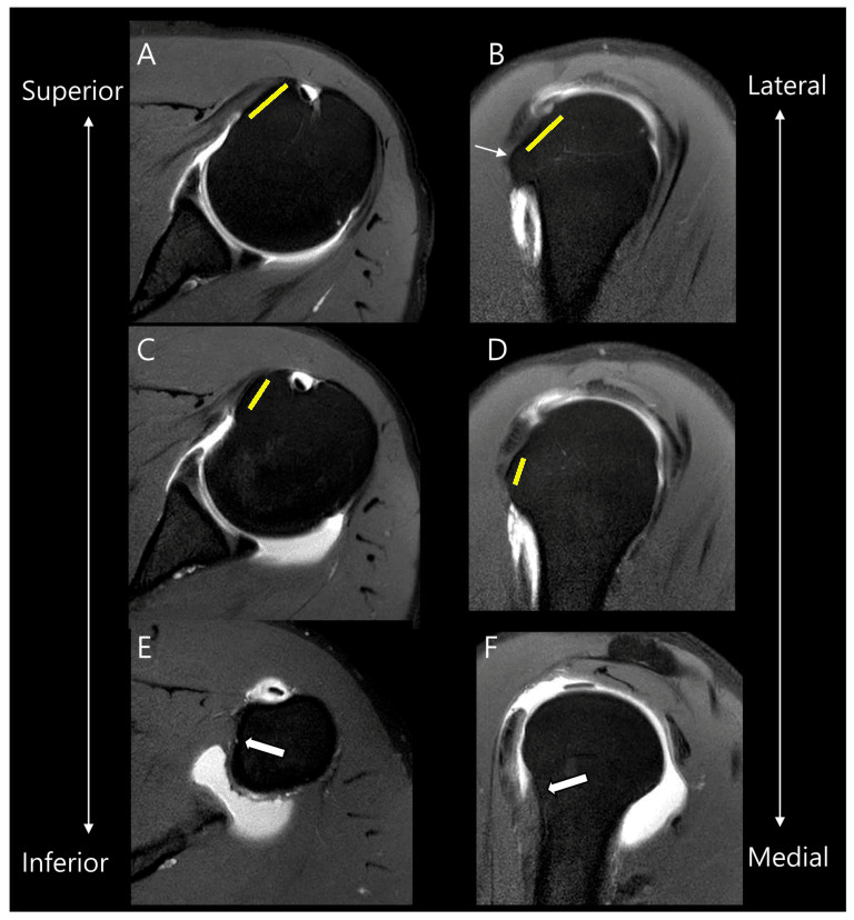 Six-panel shoulder MRI (A-F) of the subscapularis footprint, the left column ordered superior to inferior and the right column lateral to medial, with yellow lines in A-D and white arrows in E and F