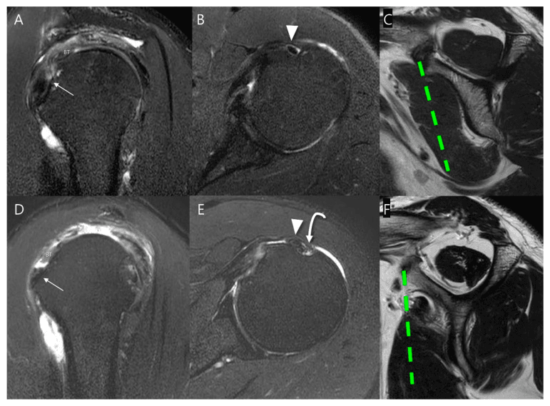 Two rows of multiplanar shoulder MRI (A-C and D-F) comparing Yoo type IIA and IIB partial subscapularis tears, with arrows beside the biceps tendon (BT), arrowheads and green dashed lines
