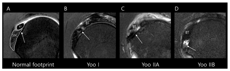 Four MRI panels labelled normal footprint (A), Yoo I (B), Yoo IIA (C) and Yoo IIB (D), with arrows at the footprint beside the biceps tendon