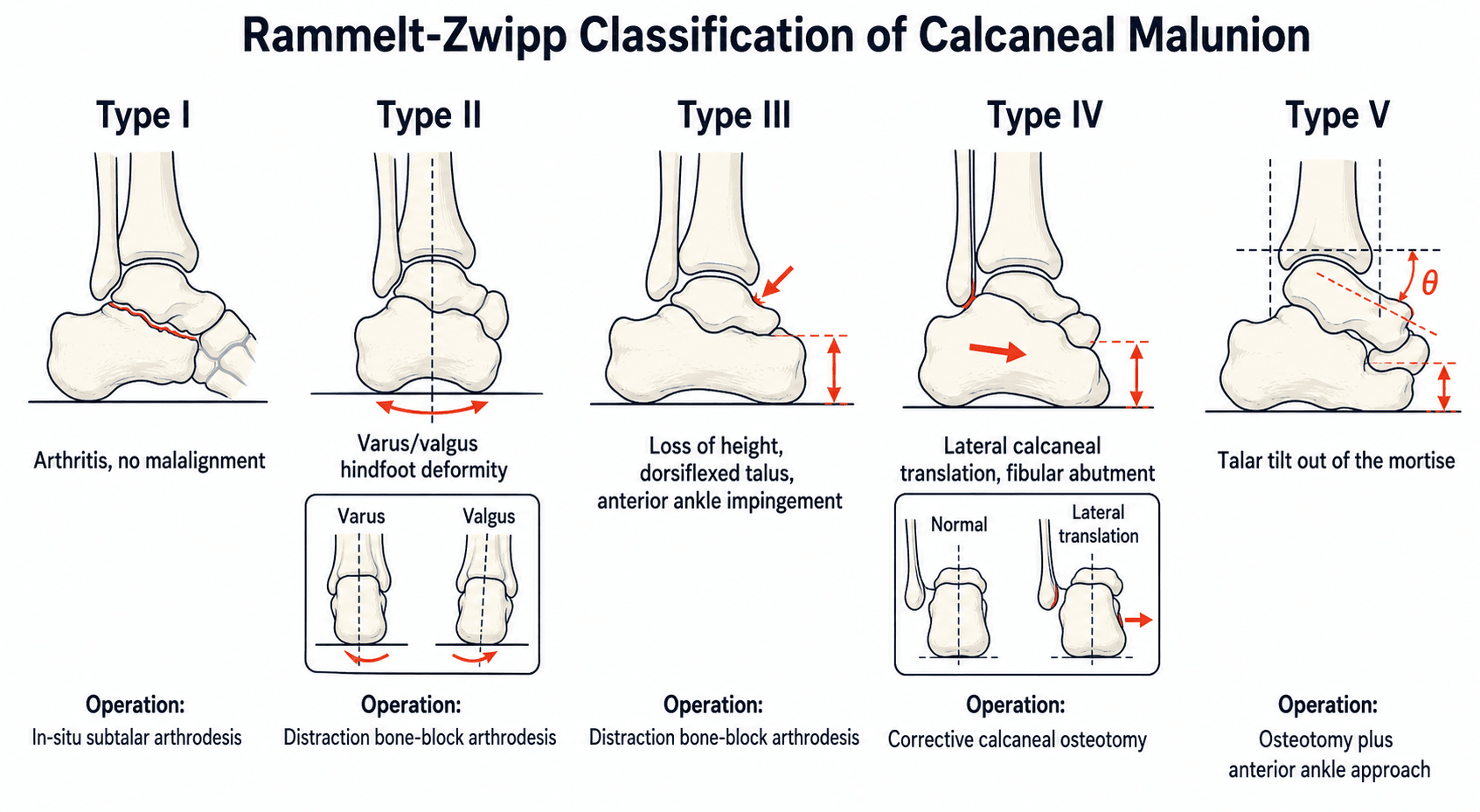 Rammelt-Zwipp classification of calcaneal malunion showing Types I-V deformities and their matching operations.