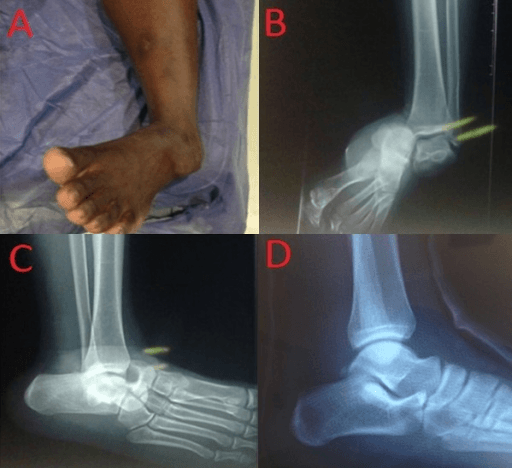 Four-panel subtalar dislocation case: clinical photograph of the deformed foot, pre-reduction lateral radiograph, intra-operative reduction with a guidewire, and post-reduction radiograph.