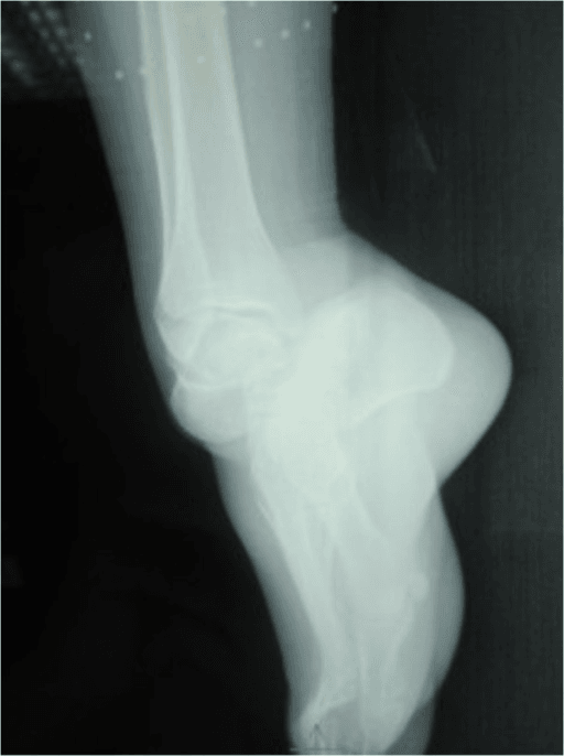 Lateral radiograph showing a medial subtalar dislocation without fracture