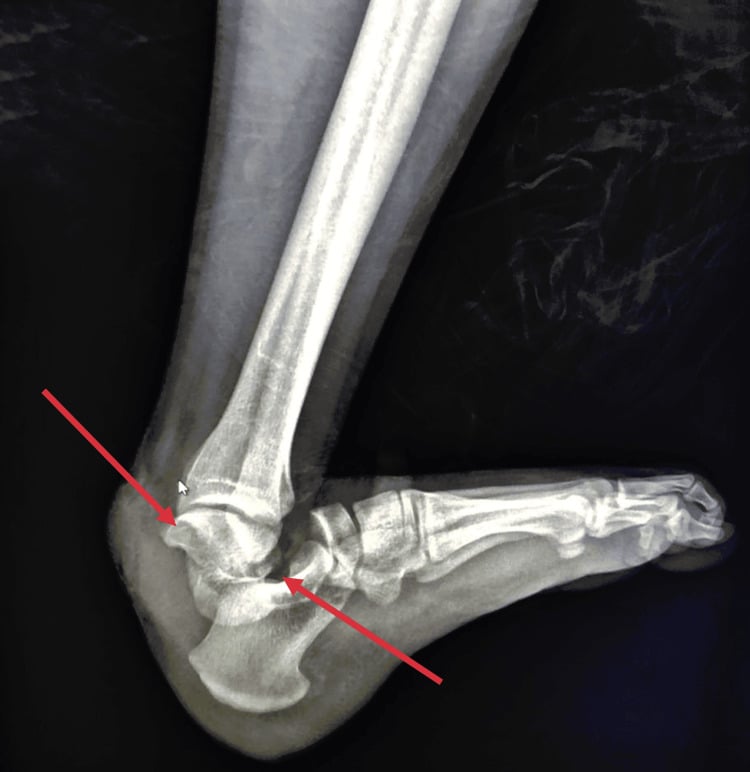 Lateral radiograph showing a subtalar dislocation with medial rotation of the talus