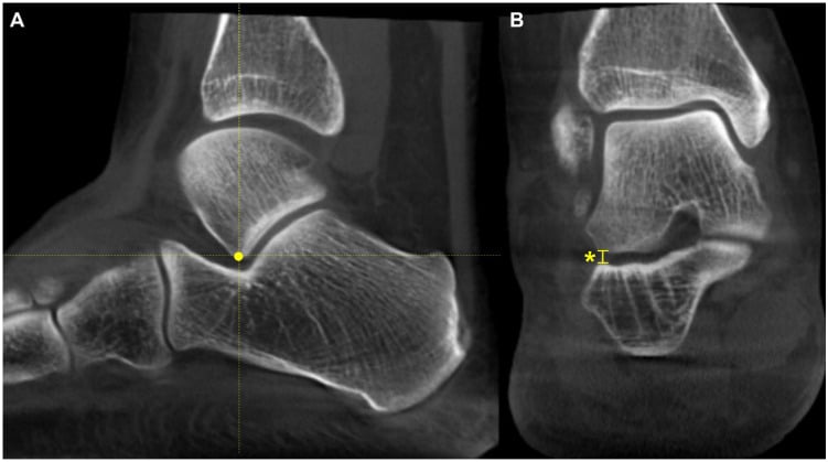 Sagittal and axial images showing measurement of the talocalcaneal distance