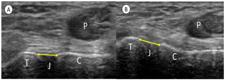 Ultrasound showing subtalar joint width at rest and in inversion