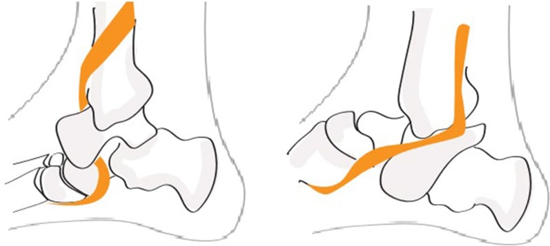 Diagram of posterior tibial tendon interposition blocking reduction of a lateral subtalar dislocation