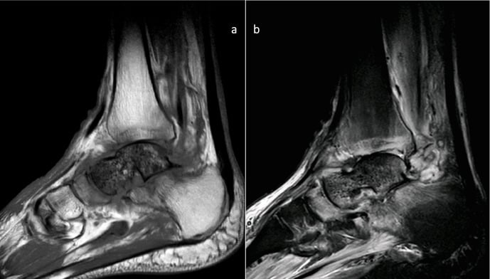 Sagittal MRI showing avascular necrosis and osteomyelitis of the talus