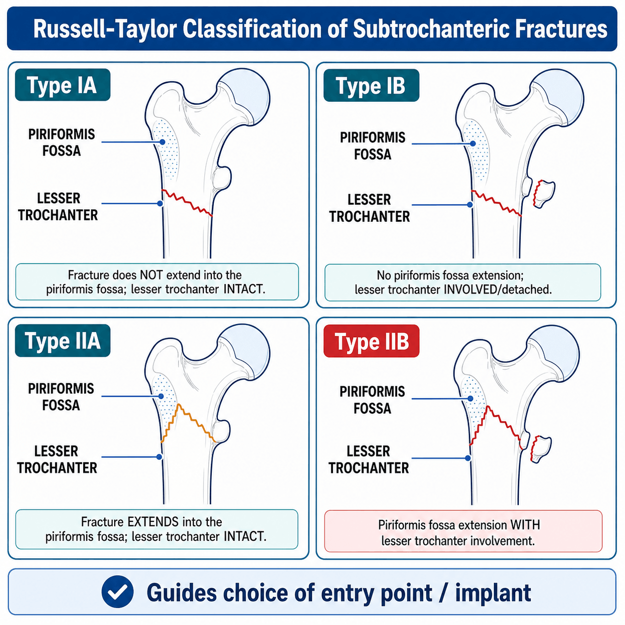 Russell-Taylor classification of subtrochanteric fractures