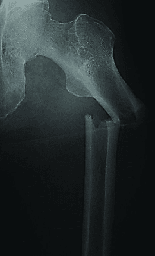 AP radiograph showing a complete transverse subtrochanteric femoral fracture with the shaft displaced medially