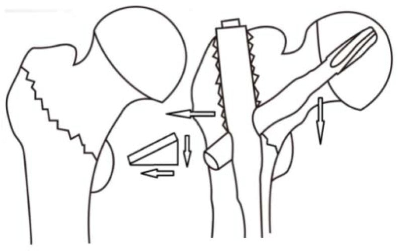 Schematic diagram illustrating deformational forces in subtrochanteric fractures