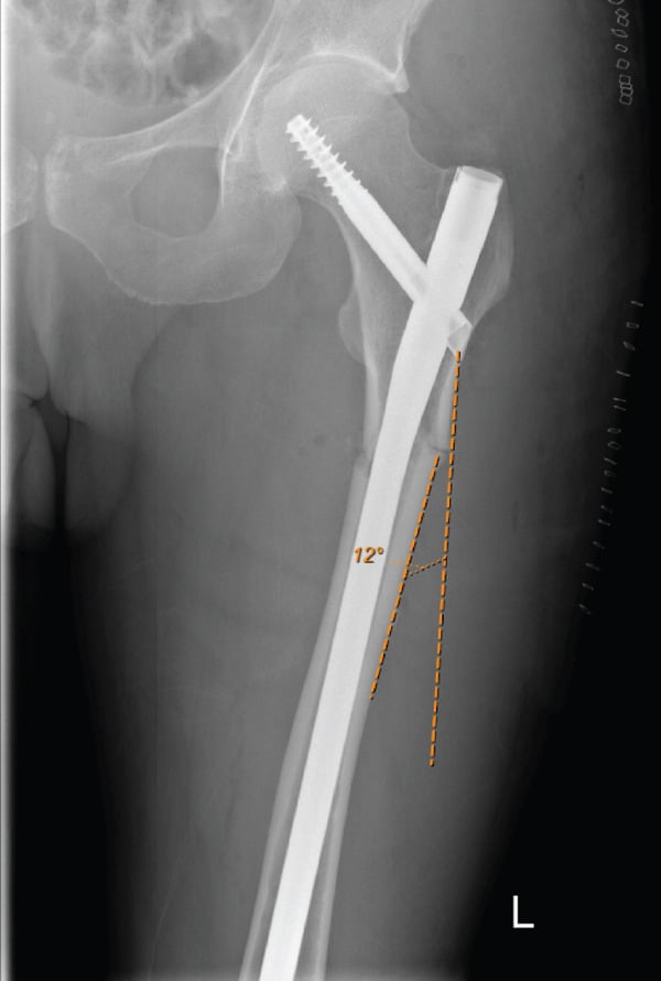 AP radiograph demonstrating subtrochanteric cephalomedullary nailing with varus malalignment