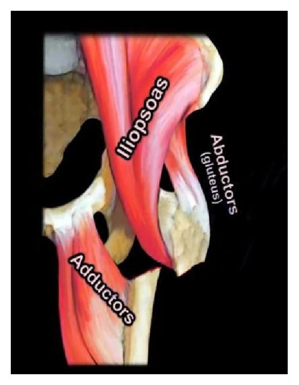 Anatomical diagram of muscle deformational forces in subtrochanteric fractures