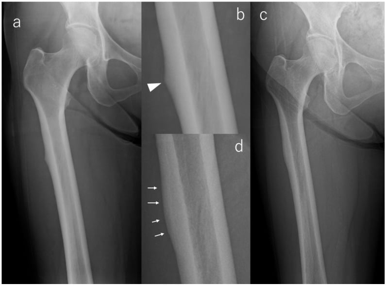 Thigh AP radiographs demonstrating atypical femoral fracture lateral cortical bump