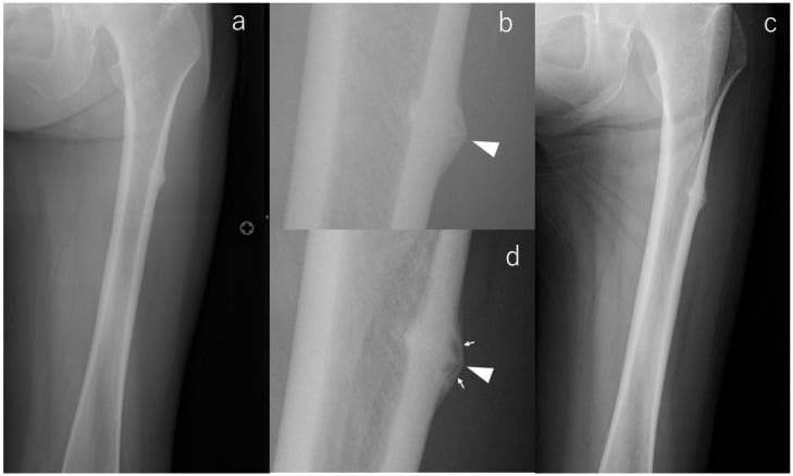 AP radiographs showing atypical subtrochanteric fracture cortical thickening