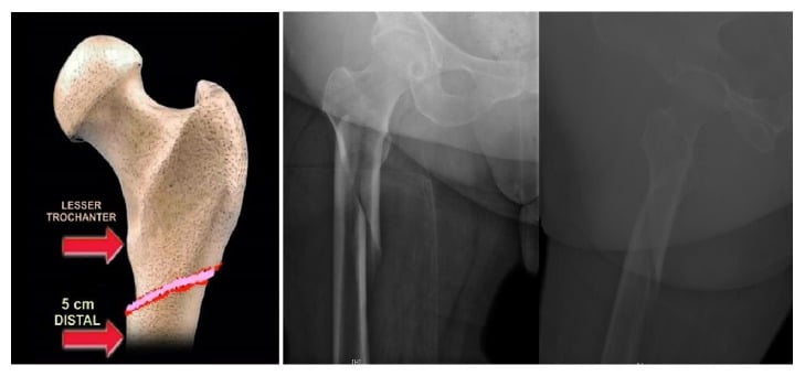 3D bone model establishing the subtrochanteric region boundary 5 cm distal to lesser trochanter