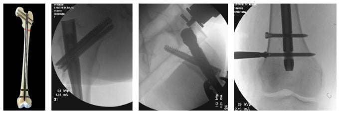 Intraoperative fluoroscopy series of cephalomedullary nailing for subtrochanteric fracture