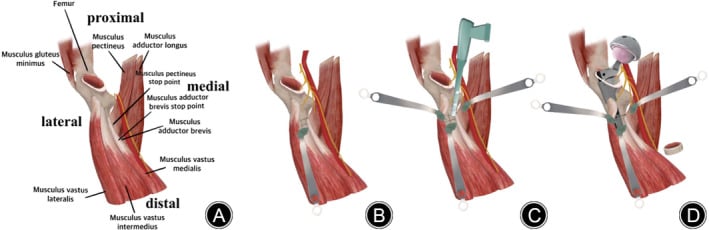 Anatomical schematic diagram of cerclage cabling and reduction clamps before nailing