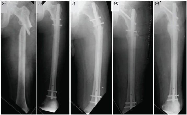 Radiographic series of subtrochanteric varus malreduction and revision exchange nailing