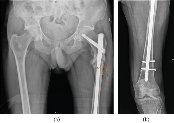 AP pelvic and femoral radiographs showing subtrochanteric nonunion and varus malalignment