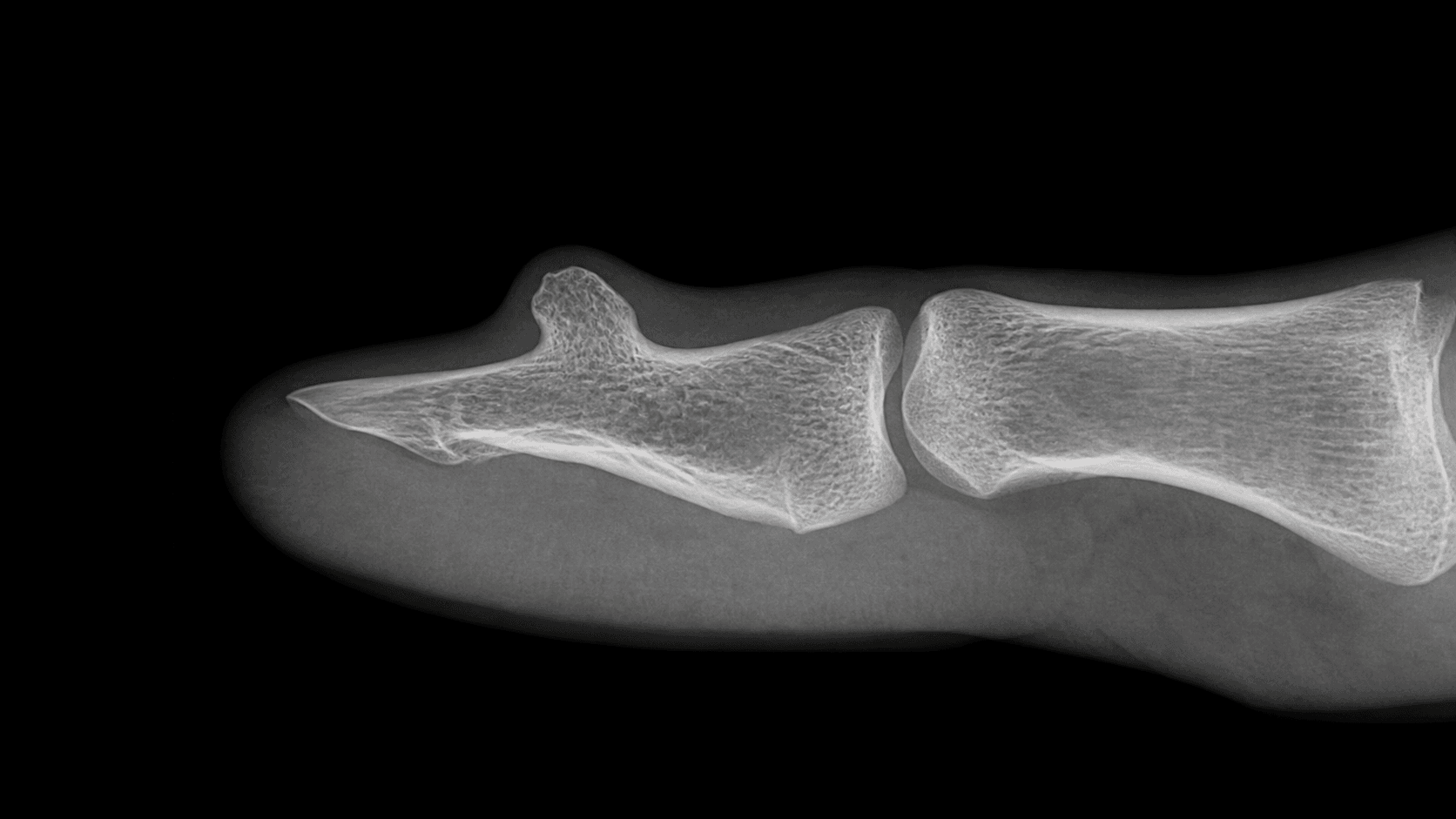 Lateral radiograph of a great toe showing a bony outgrowth projecting dorsally from the distal phalanx