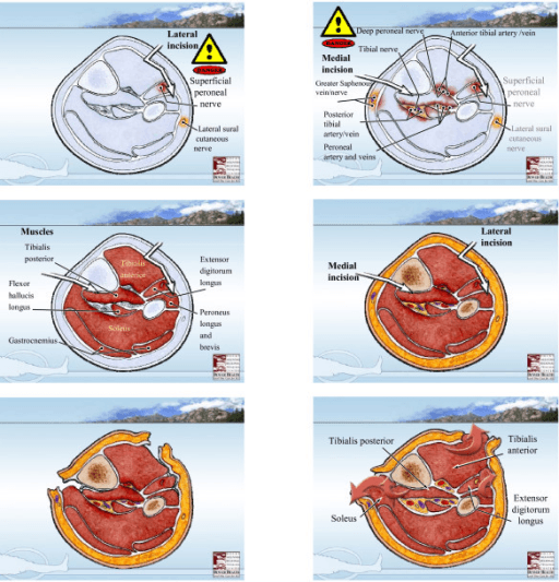 Cross-sectional sequence for two-incision four-compartment fasciotomy showing the superficial peroneal nerve and the structures at risk around the lateral compartment.