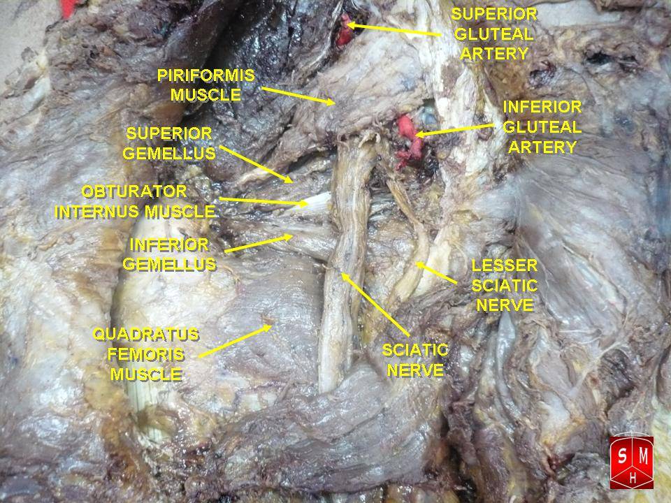 Posterior dissection of the deep gluteal region with superior gemellus labelled between piriformis and obturator internus, alongside the sciatic and lesser sciatic nerves.