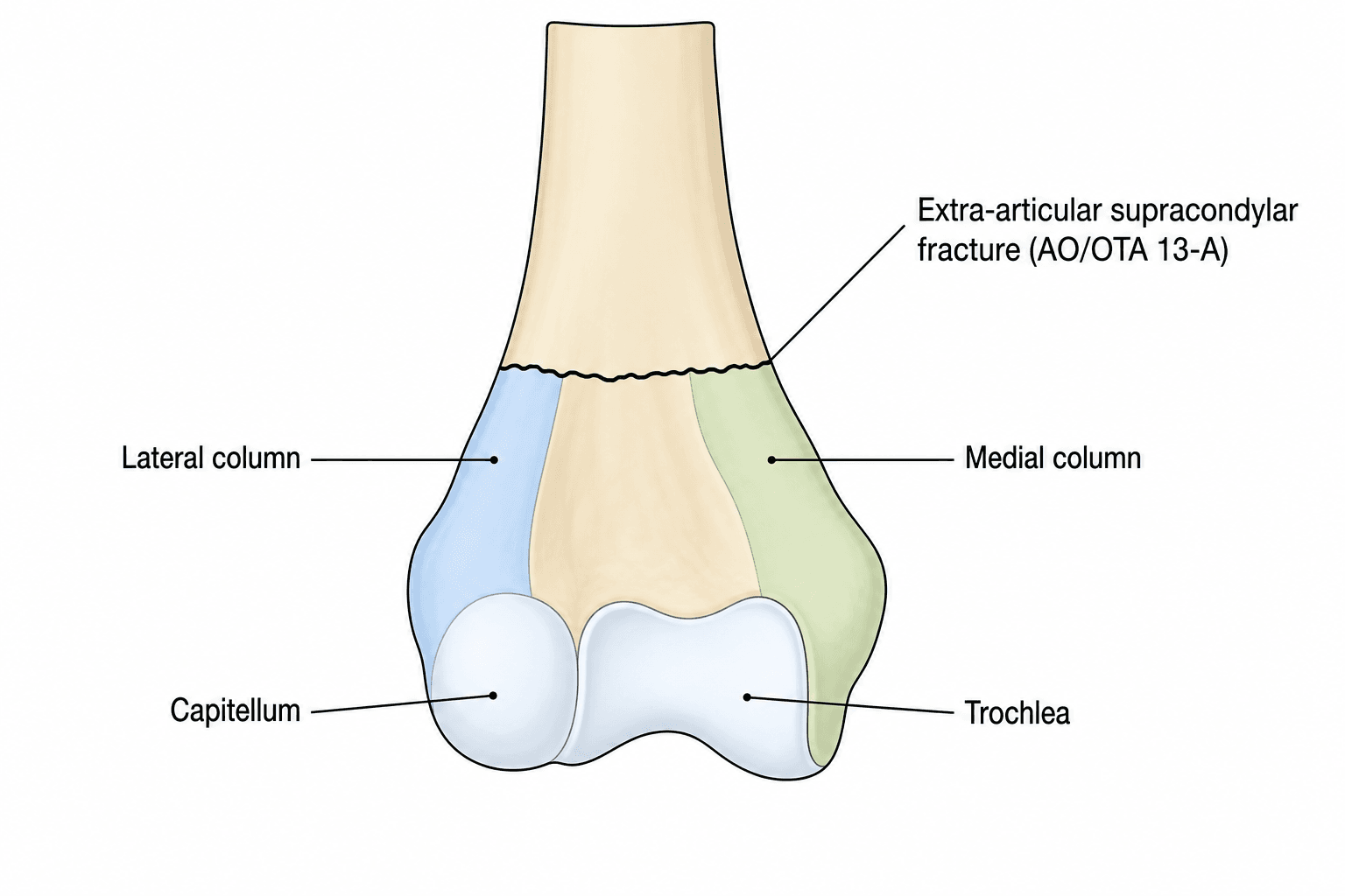 Labelled anatomical diagram of the adult distal humerus (AP view) showing the medial and lateral columns, the capitellum and trochlea, and a transverse extra-articular supracondylar fracture line.