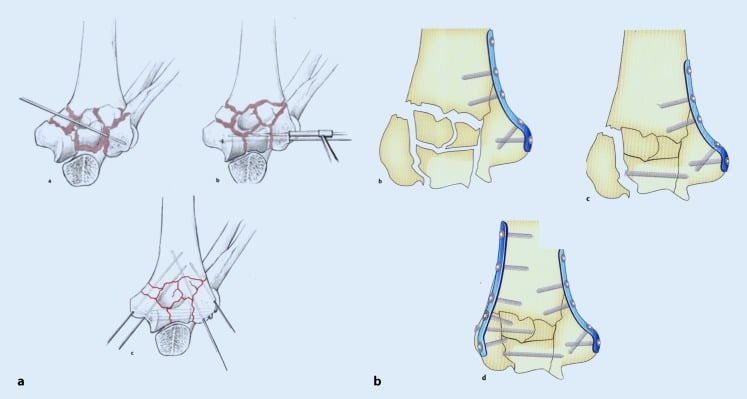 Drawings of distal humerus reduction: (a) articular fragments reduced with K-wires and a clamp; (b) one column plated, the articular fragments fixed to it with a transverse screw, then the second column plated