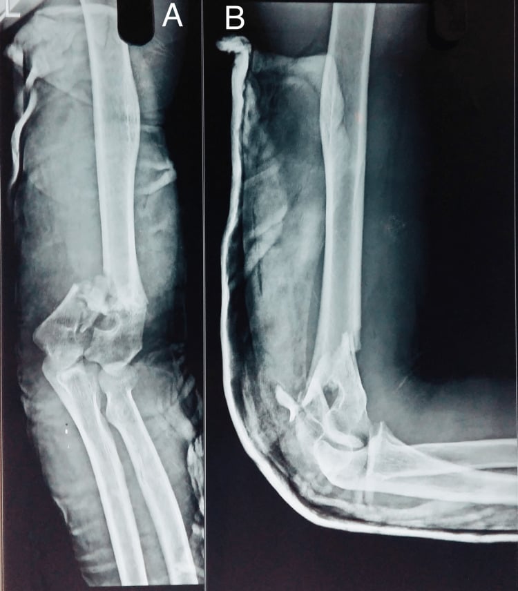 Preoperative AP (A) and lateral (B) radiographs of a comminuted distal humerus fracture in a plaster slab