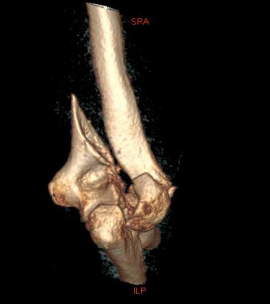 Three-dimensional CT reconstruction of a comminuted distal humerus fracture with multiple displaced fragments