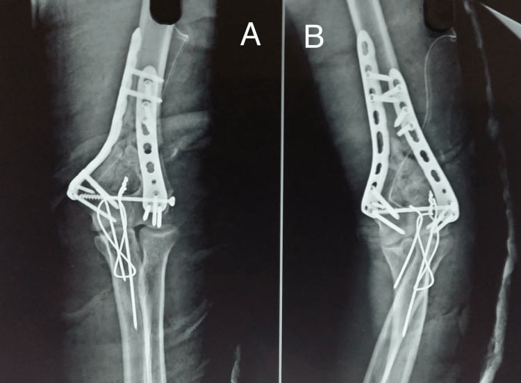 Postoperative radiographs (A, B) of a distal humerus fracture fixed with two column plates and tension-band wiring of an olecranon osteotomy