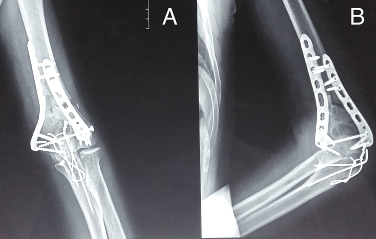 Six-month AP (A) and lateral (B) radiographs of a dual-plated distal humerus fracture with olecranon osteotomy fixation
