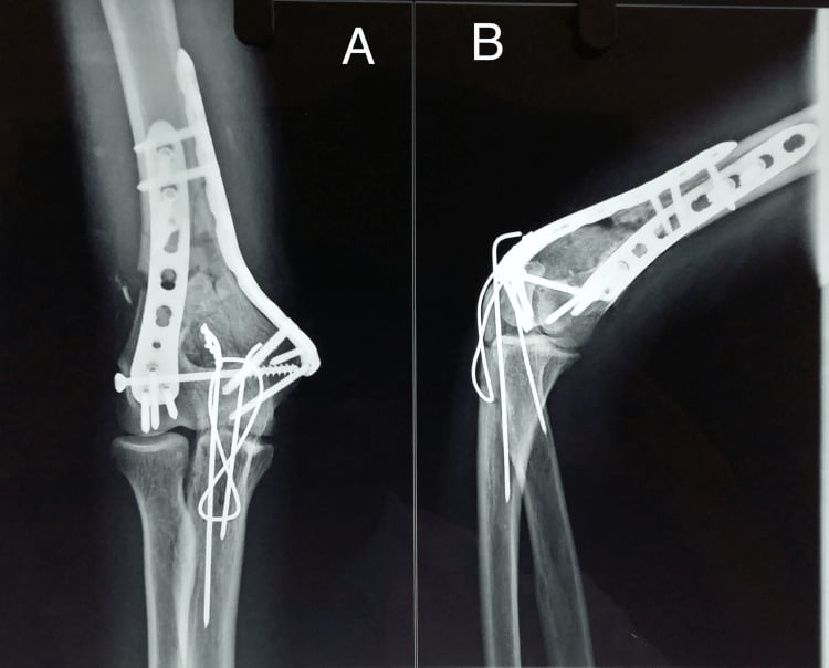 Three-month AP (A) and lateral (B) radiographs of a dual-plated distal humerus fracture with tension-band fixation of an olecranon osteotomy