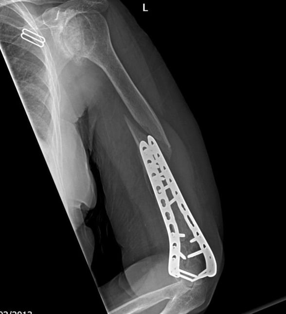 Radiograph of the humerus showing a fracture of the shaft at the proximal end of distal humerus plates
