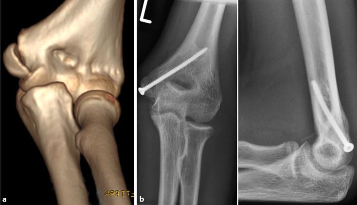 Three-dimensional CT (a) and postoperative AP and lateral radiographs (b) of an AO/OTA 13-A1 distal humerus fracture fixed with a single screw