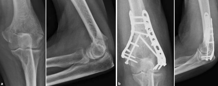 Preoperative (a) and postoperative (b) AP and lateral radiographs of an AO/OTA 13-A2 fracture fixed with two column plates