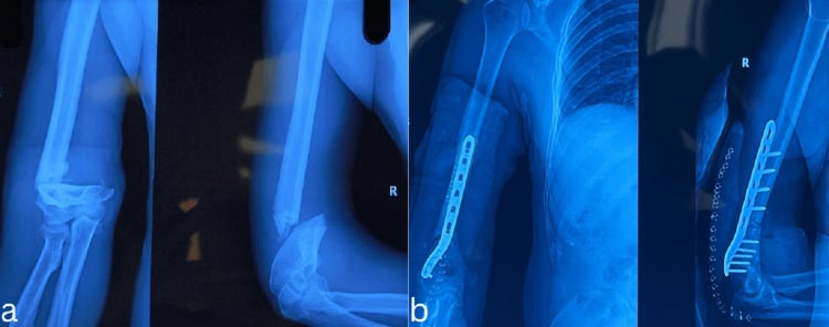Preoperative (a) and postoperative (b) radiographs of an extra-articular AO/OTA 13-A2 distal humerus fracture treated with plate fixation