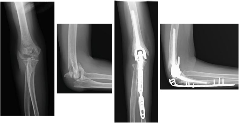 Preoperative AP and lateral radiographs of a distal humeral fracture and postoperative AP and lateral radiographs after total elbow arthroplasty, with a plate along the ulna