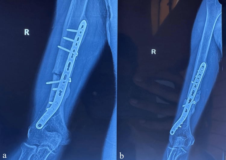 Two radiographs (a, b) showing failure of a distal humerus plate construct before union