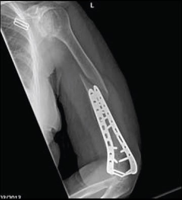 Lower-resolution copy of the same radiograph, showing a periprosthetic fracture above distal humerus fixation