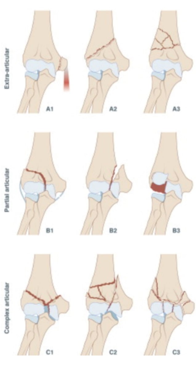 AO/OTA classification diagram for adult distal humerus fractures