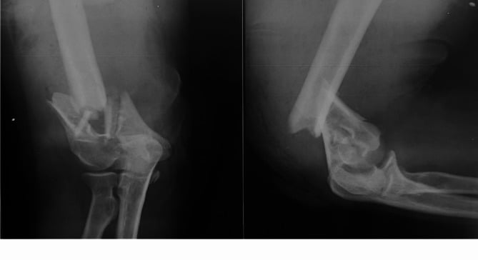 Preoperative radiographs, 3D CT, and postoperative radiographs of parallel dual-plate ORIF