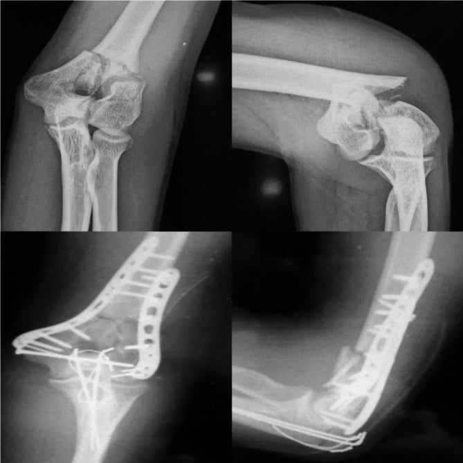 Preoperative radiographs, 3D CT, and postoperative radiographs of orthogonal 90-90 dual-plate ORIF