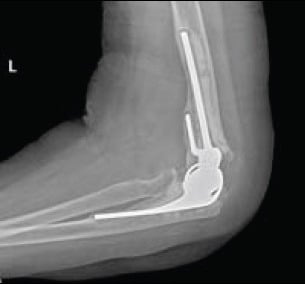 Lateral radiograph showing loosening of a total elbow arthroplasty