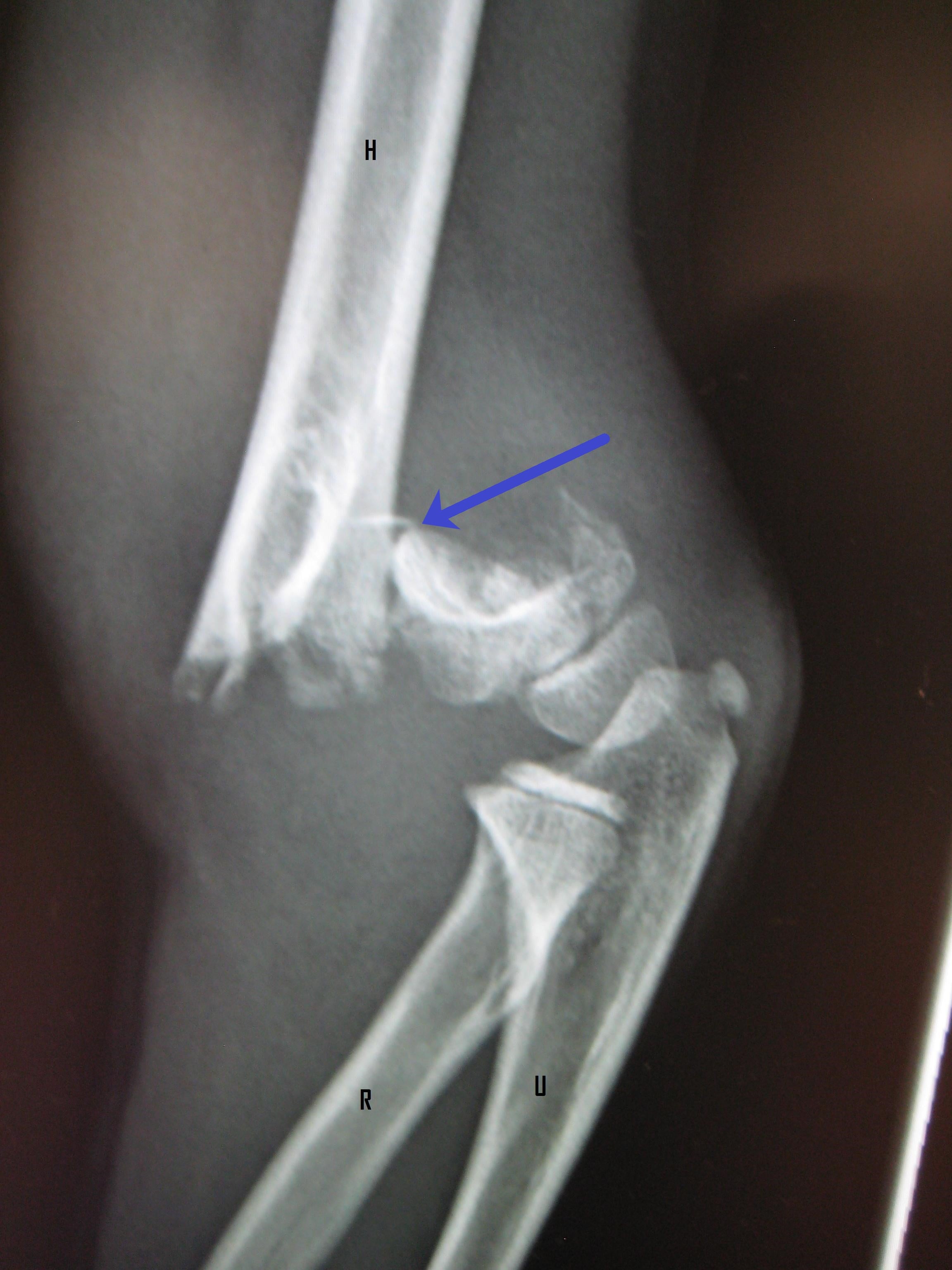 Elbow X-ray showing supracondylar fracture in a child with labeled anatomy