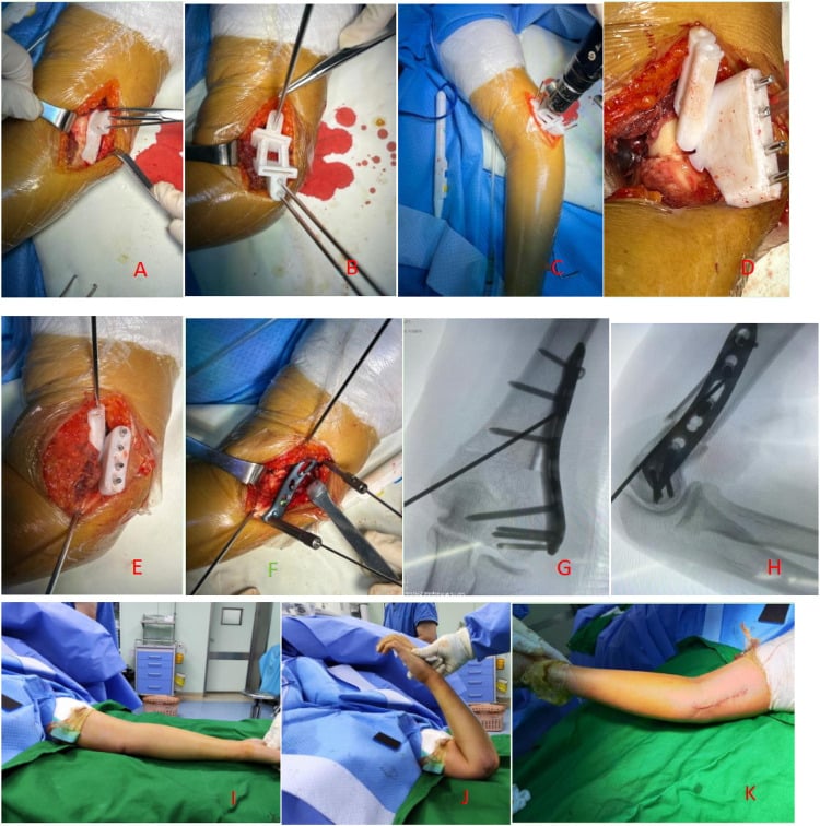 Operative sequence of patient-specific guide assisted multiplanar cubitus varus osteotomy and fixation